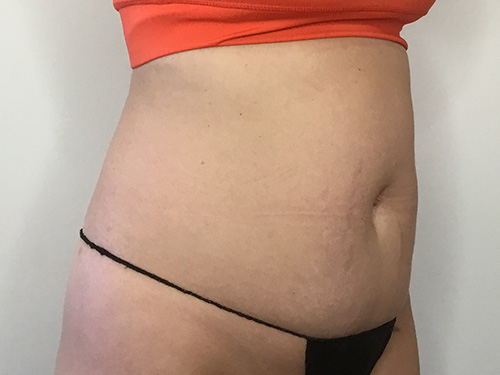 Tummy Tuck Before and After | CIARAVINO Plastic Surgery