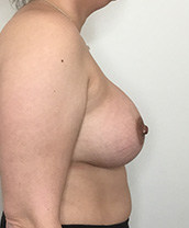 Breast Augmentation Silicone Implants Before and After | CIARAVINO Plastic Surgery