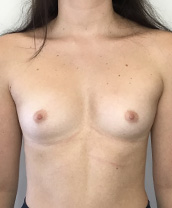 Breast Augmentation Silicone Implants Before and After | CIARAVINO Plastic Surgery