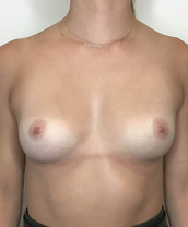 Breast Augmentation Silicone Implants Before and After | CIARAVINO Plastic Surgery