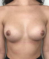 Breast Augmentation Silicone Implants Before and After | CIARAVINO Plastic Surgery