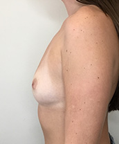 Breast Augmentation Silicone Implants Before and After | CIARAVINO Plastic Surgery