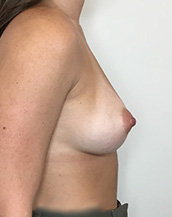 Breast Augmentation Silicone Implants Before and After | CIARAVINO Plastic Surgery