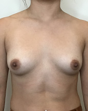 Breast Augmentation Silicone Implants Before and After | CIARAVINO Plastic Surgery