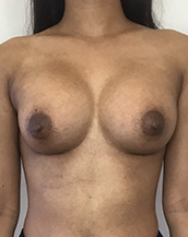 Breast Augmentation Silicone Implants Before and After | CIARAVINO Plastic Surgery