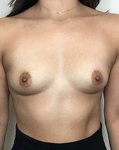 Breast Augmentation Silicone Implants Before and After | CIARAVINO Plastic Surgery