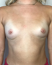 Breast Augmentation Silicone Implants Before and After | CIARAVINO Plastic Surgery