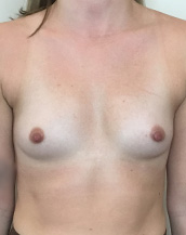 Breast Augmentation Silicone Implants Before and After | CIARAVINO Plastic Surgery