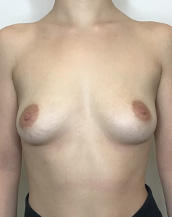 Breast Augmentation Silicone Implants Before and After | CIARAVINO Plastic Surgery