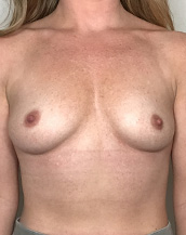 Breast Augmentation Silicone Implants Before and After | CIARAVINO Plastic Surgery