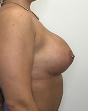 Breast Augmentation Silicone Implants Before and After | CIARAVINO Plastic Surgery