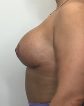 Breast Augmentation Silicone Implants Before and After | CIARAVINO Plastic Surgery