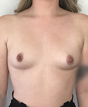 Breast Augmentation Silicone Implants Before and After | CIARAVINO Plastic Surgery