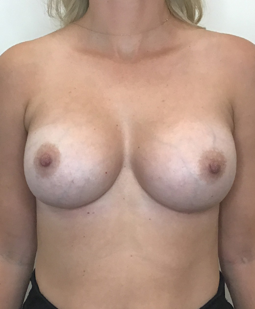 Breast Implant Revision Before and After | CIARAVINO Plastic Surgery