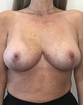 Breast Lift With Implants Before and After | CIARAVINO Plastic Surgery