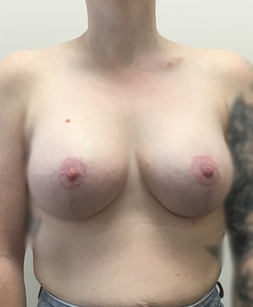 Breast Lift With Implants Before and After | CIARAVINO Plastic Surgery